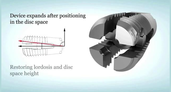 Image of Wenzel Spine Varilift® Interbody Fusion System, highlighted in marketing video.